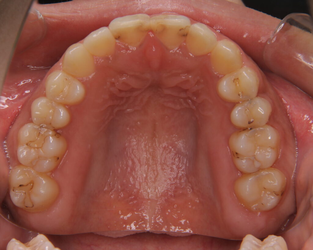 叢生・八重歯の治療例６（治療後上顎咬合面）
