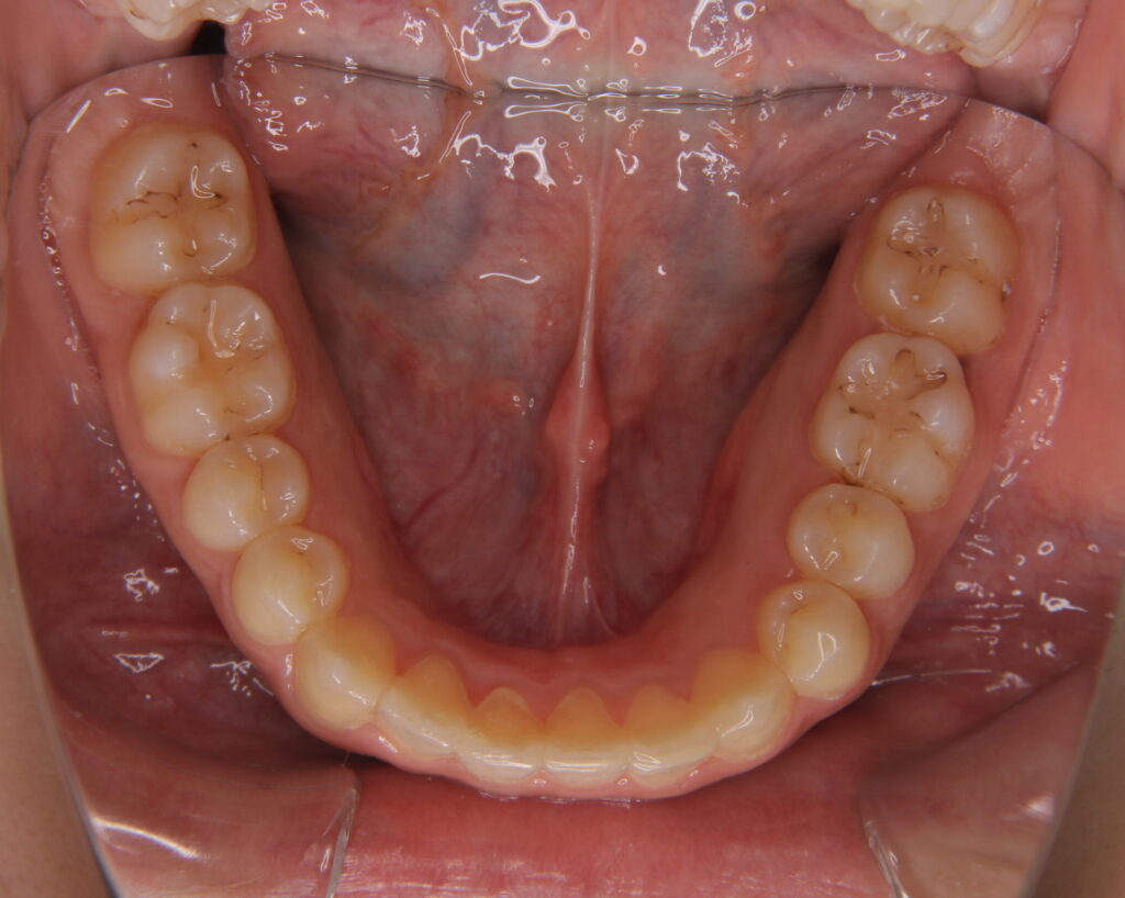 叢生・八重歯の治療例６（治療後下顎咬合面）