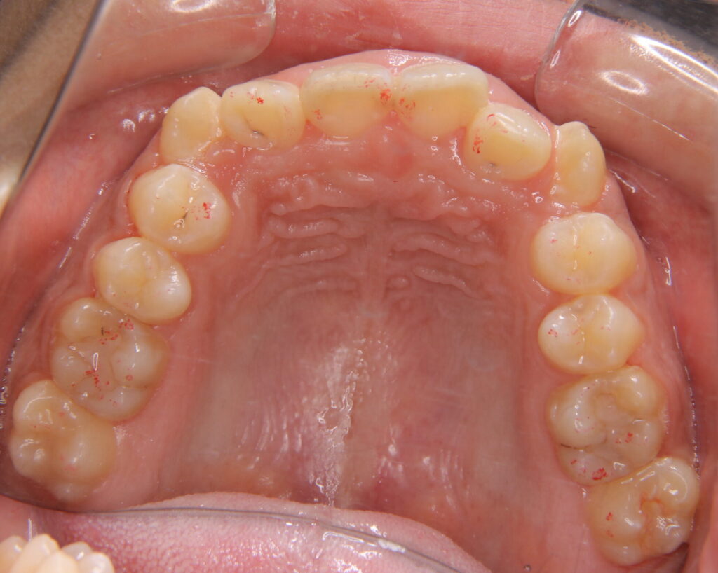 叢生・八重歯の治療例５（治療前咬合面上顎）
