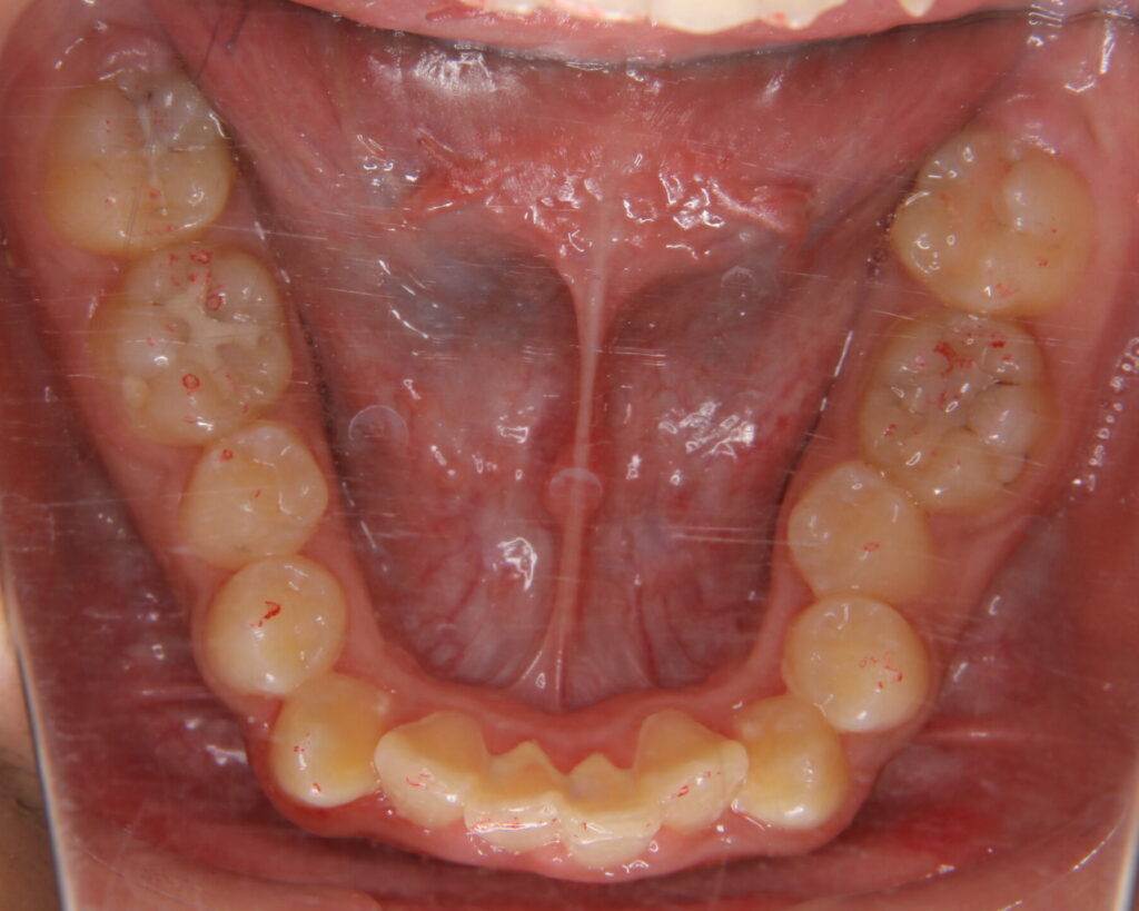 叢生・八重歯の治療例５（治療前咬合面下顎）